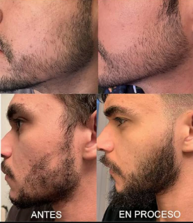 SHAMPOO PARA EL CRECIMIENTO DEL CABELLO Y BARBA For Men®