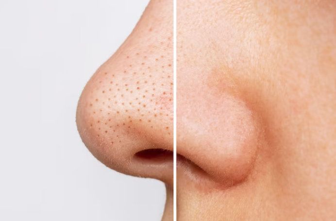 BANDAS PARA ELIMINAR PUNTOS NEGROS DE LA NARIZ Skin Bliss® 🌚