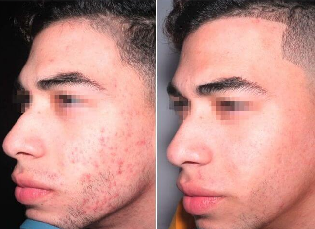 SERUM ACIDO HIALURONICO Vitality Men® 👱♂️