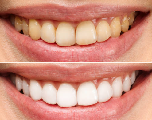 CREMA DE DIENTES BLANQUEADORA BAMBÚ Y CARBÓN ACTIVADO Tooth Paste® 🦷